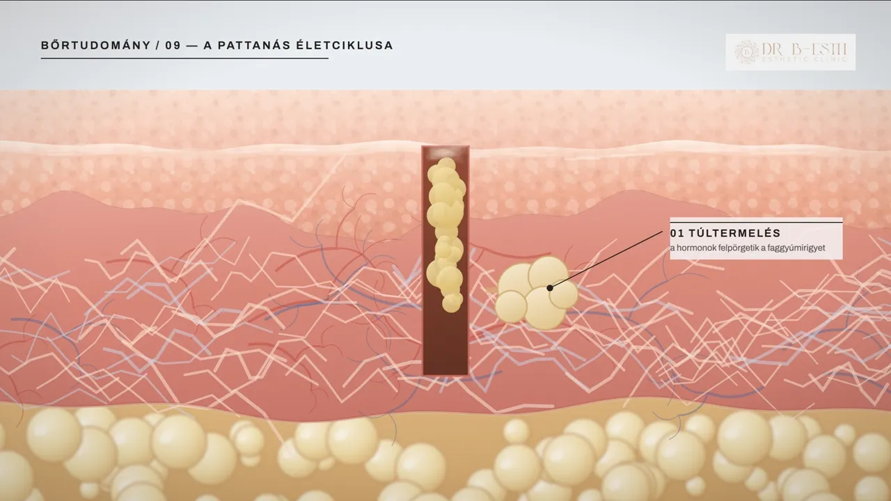 A pattanás életciklusa